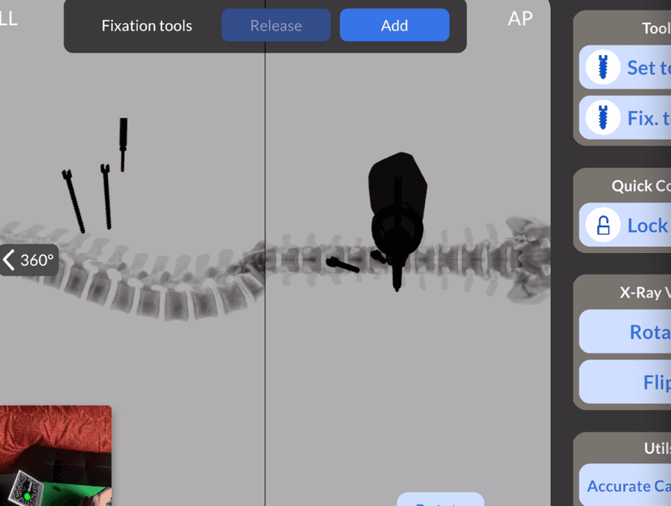 Mobile X-ray interface showing multiple fixation tools